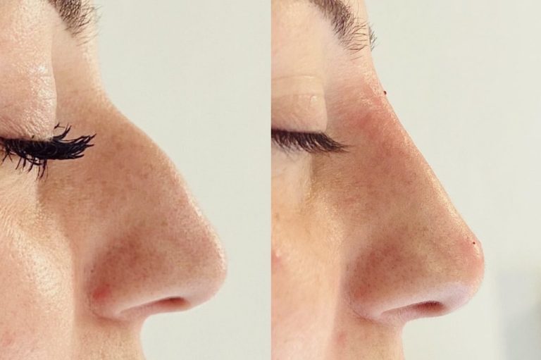 Nose Filler Rhinoplasty