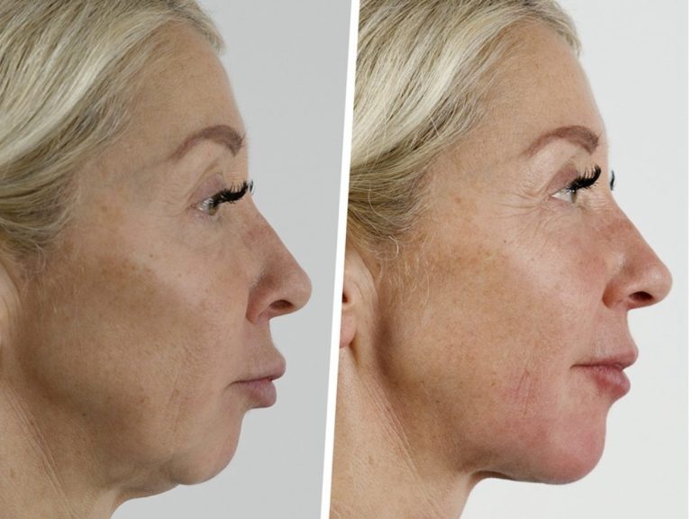 Dermal fillers in London Dermal Fillers London
