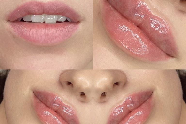lip filler London lip filler